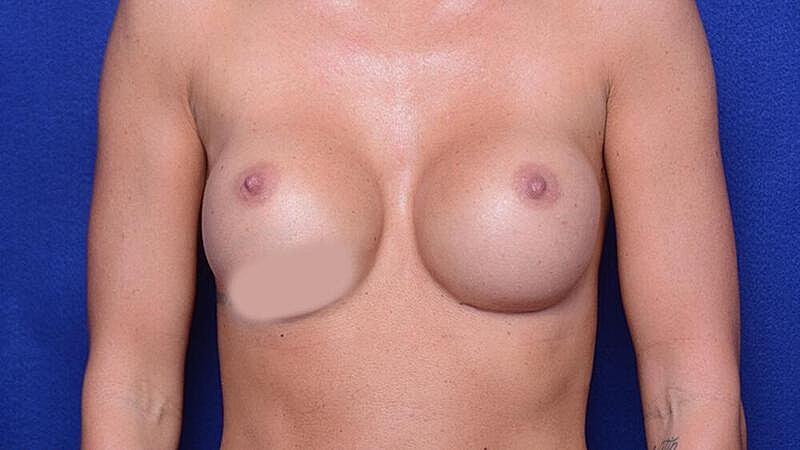 Breast Revision Before & After
