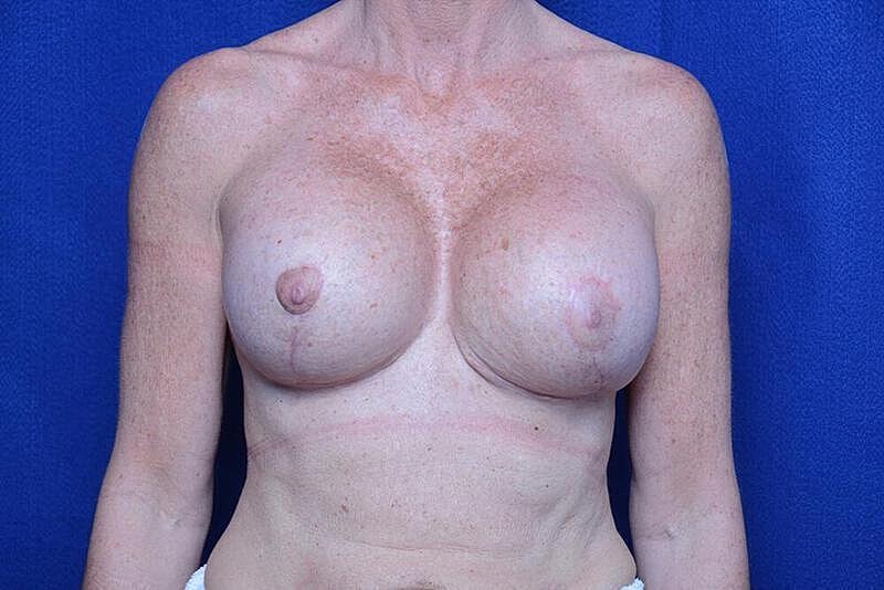 Breast Revision Before & After