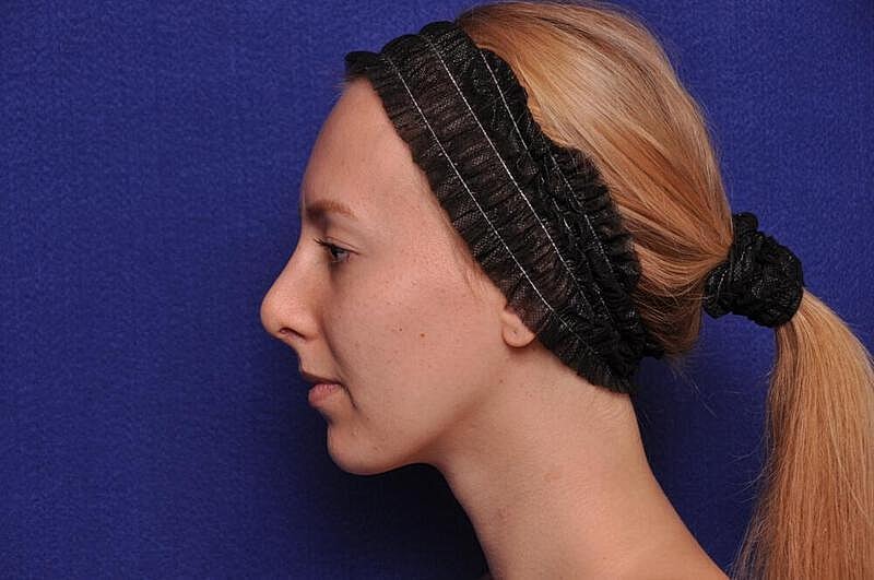 Rhinoplasty Before & After