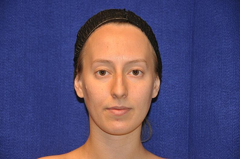 Rhinoplasty Before & After