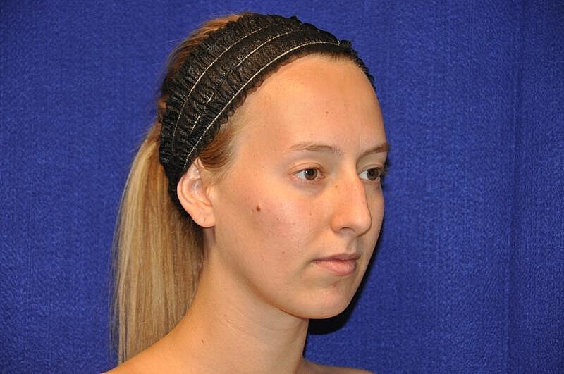 Rhinoplasty Before & After
