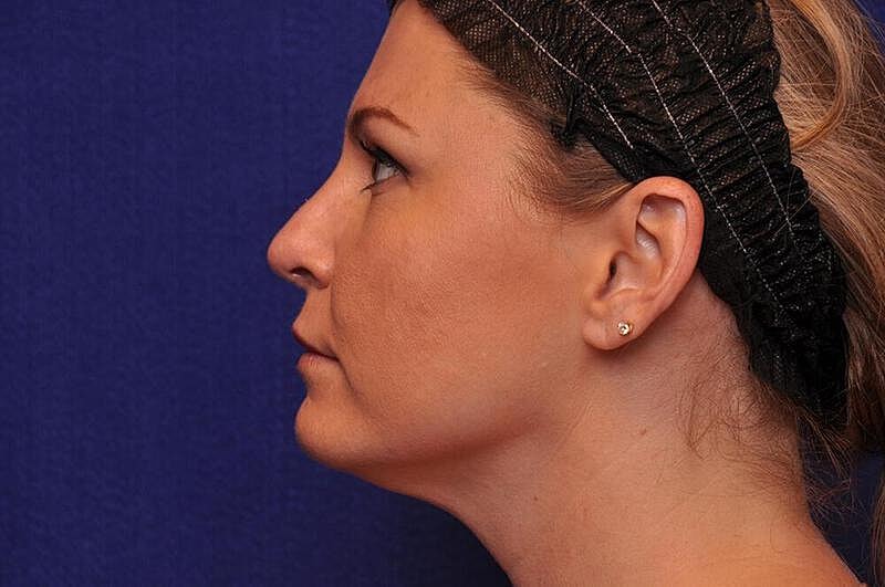 Rhinoplasty Before & After
