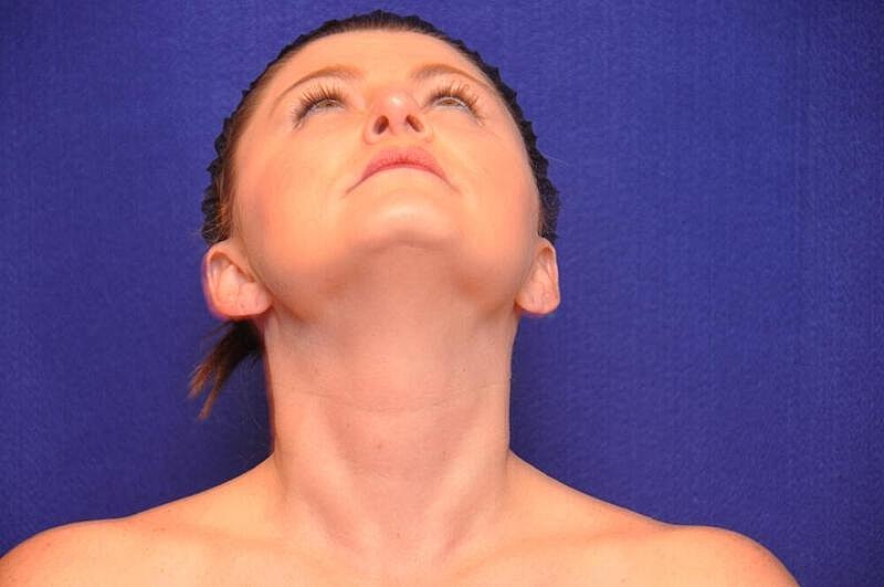 Rhinoplasty Before & After