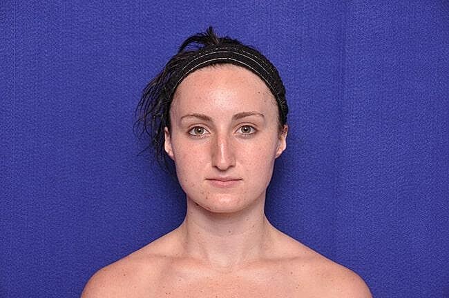 Rhinoplasty Before & After