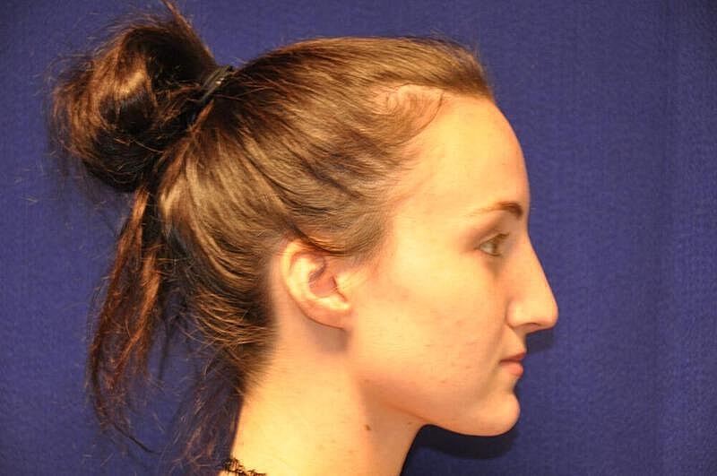 Rhinoplasty Before & After