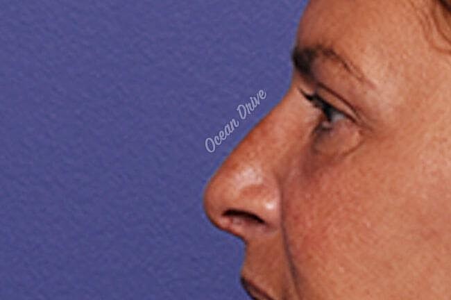 Rhinoplasty Before & After