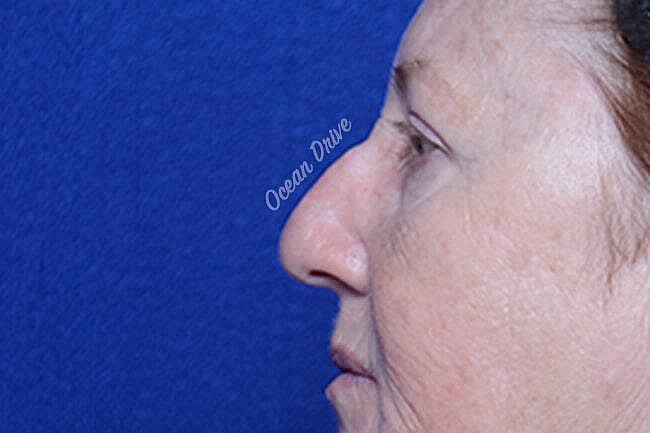 Rhinoplasty Before & After