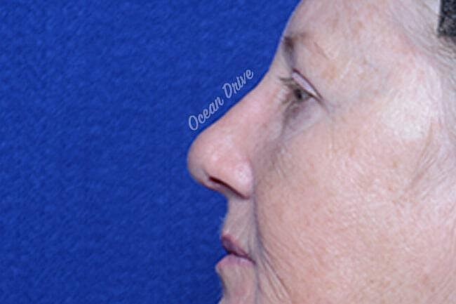 Rhinoplasty Before & After