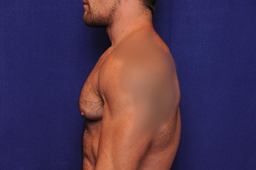 Athletic Gynecomastia Surgery Before & After