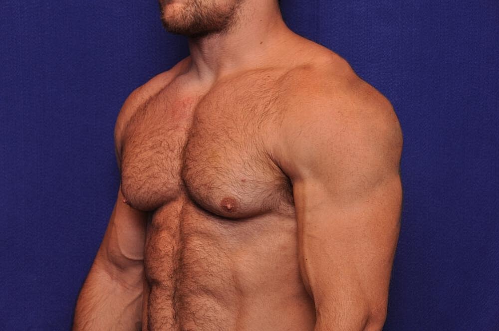 Athletic Gynecomastia Surgery Before & After