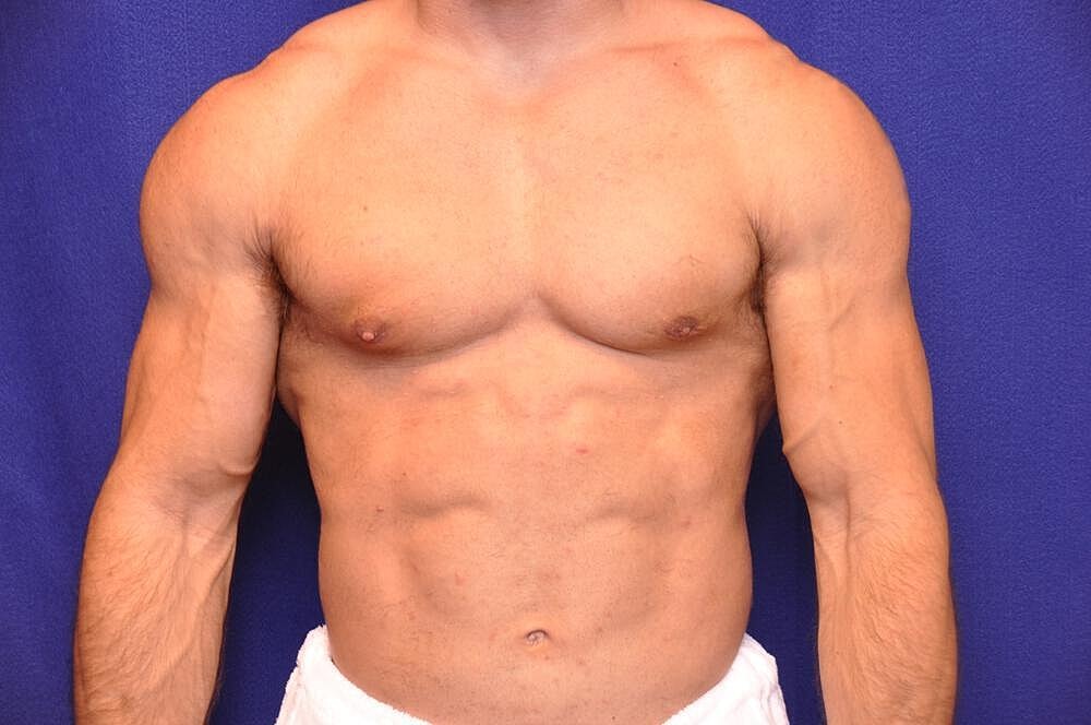 Athletic Gynecomastia Surgery Before & After