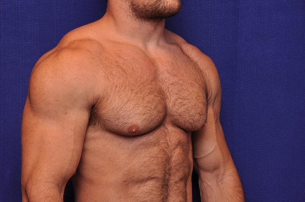 Athletic Gynecomastia Surgery Before & After