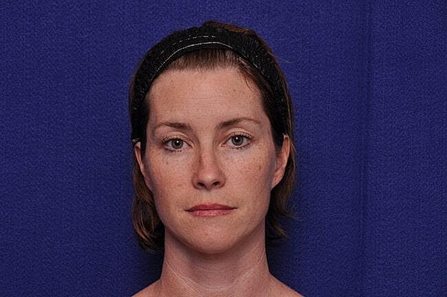 Chemical Brow Lift Before & After