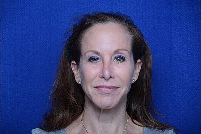 Chemical Brow Lift Before & After