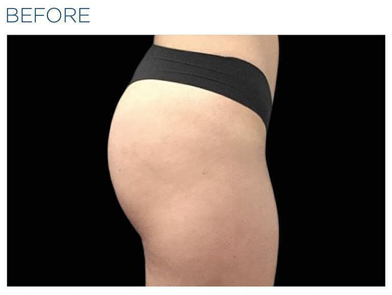 Emsculpt Gluteal Before & After
