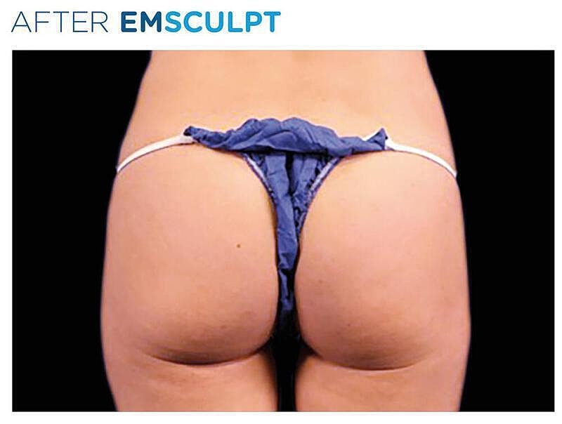 Emsculpt Gluteal Before & After