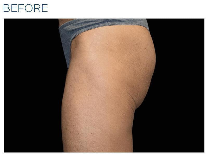 Emsculpt Gluteal Before & After