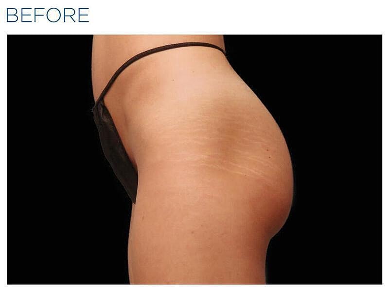 Emsculpt Gluteal Before & After