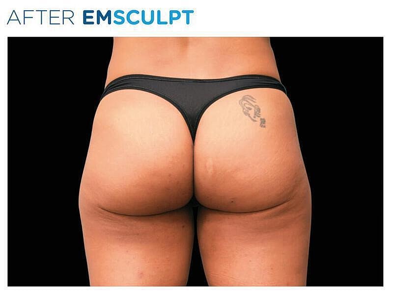 Emsculpt Gluteal Before & After