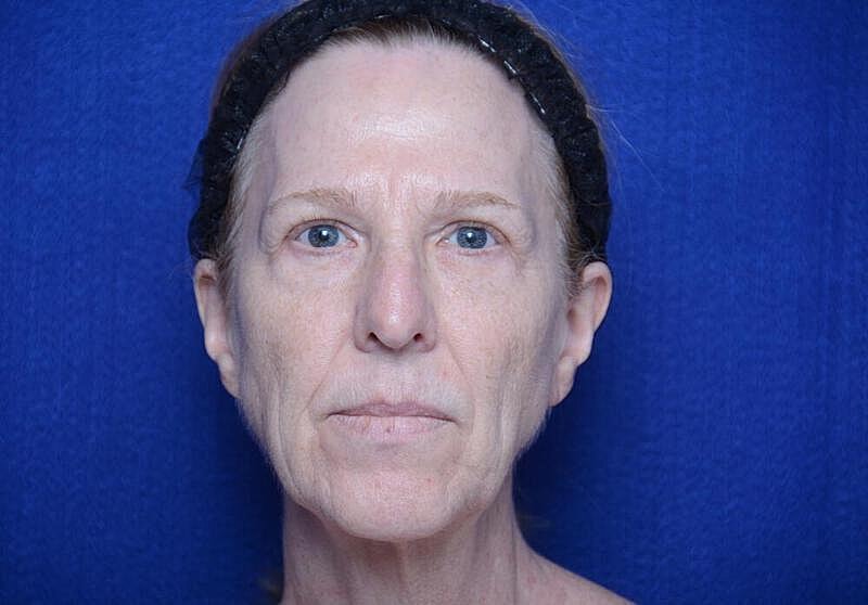 Facelift Before & After