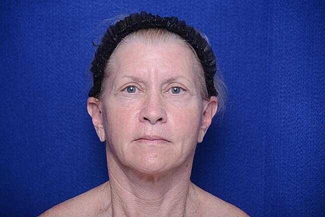 Facelift Before & After