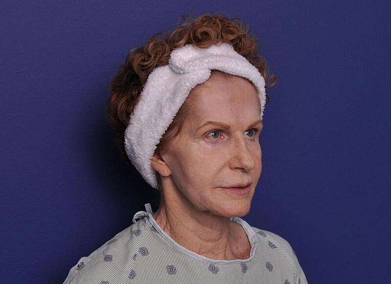 Facelift Before & After