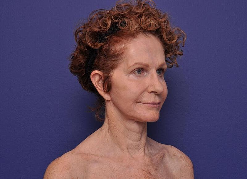 Facelift Before & After