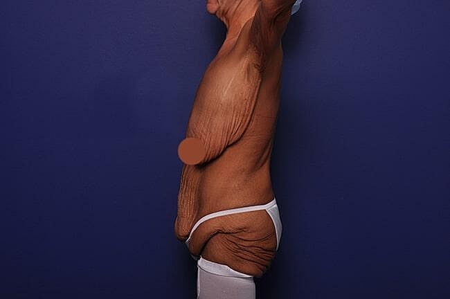 After Massive Weight Loss Surgery Before & After