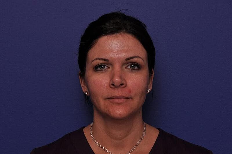 Fractional Laser Before & After