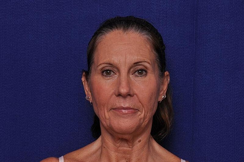 Fractional Laser Before & After