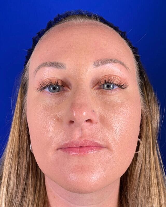 Injectables Before & After