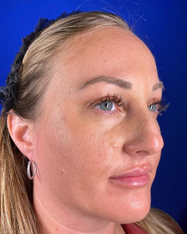 Injectables Before & After