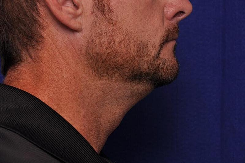 Kybella Before & After