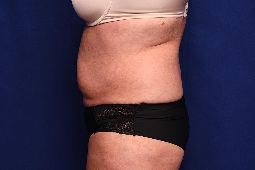 Tummy Tuck Before & After