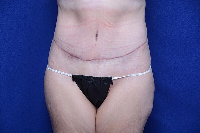Tummy Tuck Before & After
