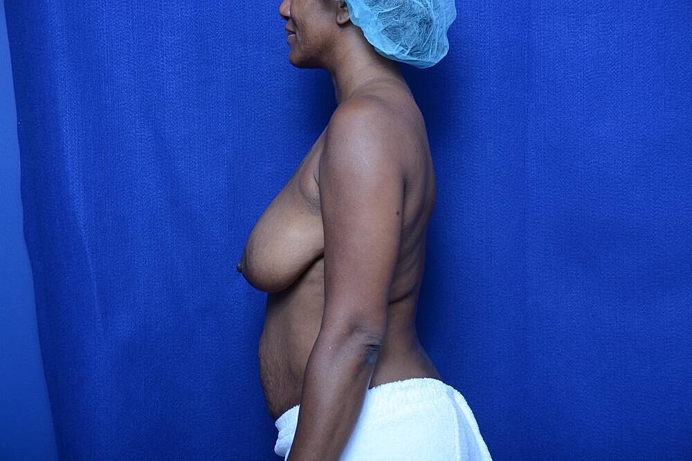 Tummy Tuck Before & After