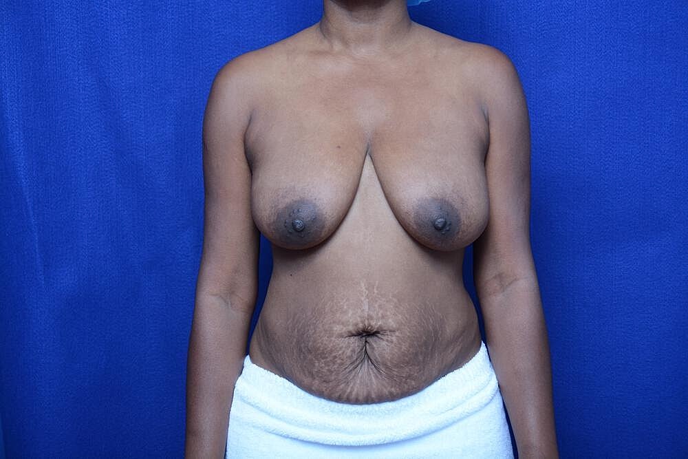 Tummy Tuck Before & After