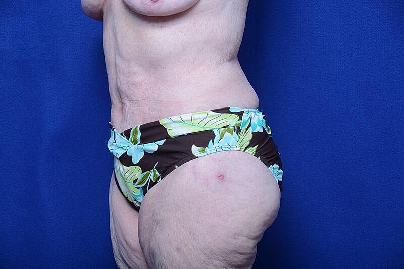 Tummy Tuck Before & After