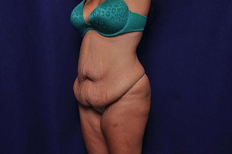 Tummy Tuck Before & After