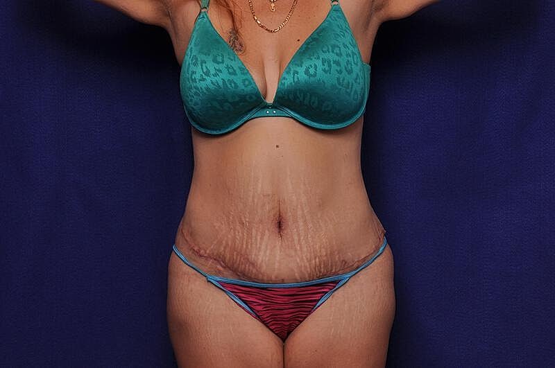 Tummy Tuck Before & After