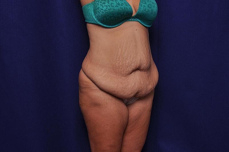 Tummy Tuck Before & After