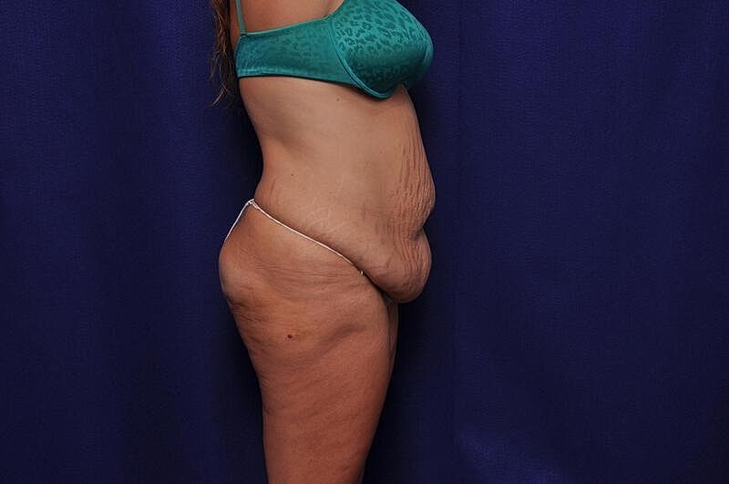 Tummy Tuck Before & After