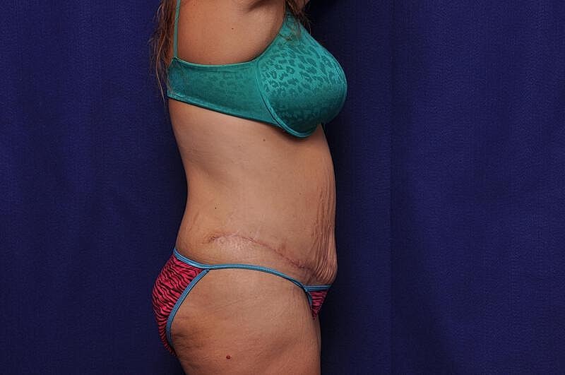 Tummy Tuck Before & After
