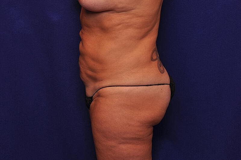 Tummy Tuck Before & After