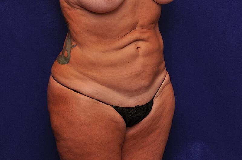 Tummy Tuck Before & After