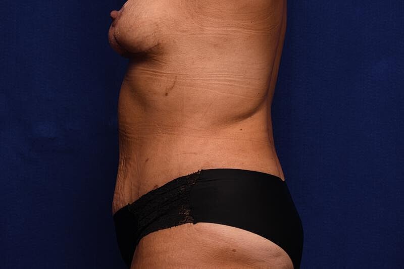 Tummy Tuck Before & After
