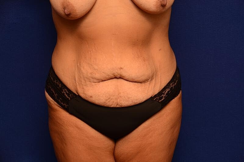 Tummy Tuck Before & After