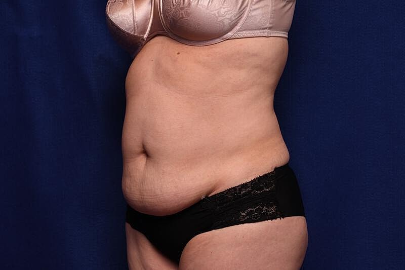 Tummy Tuck Before & After