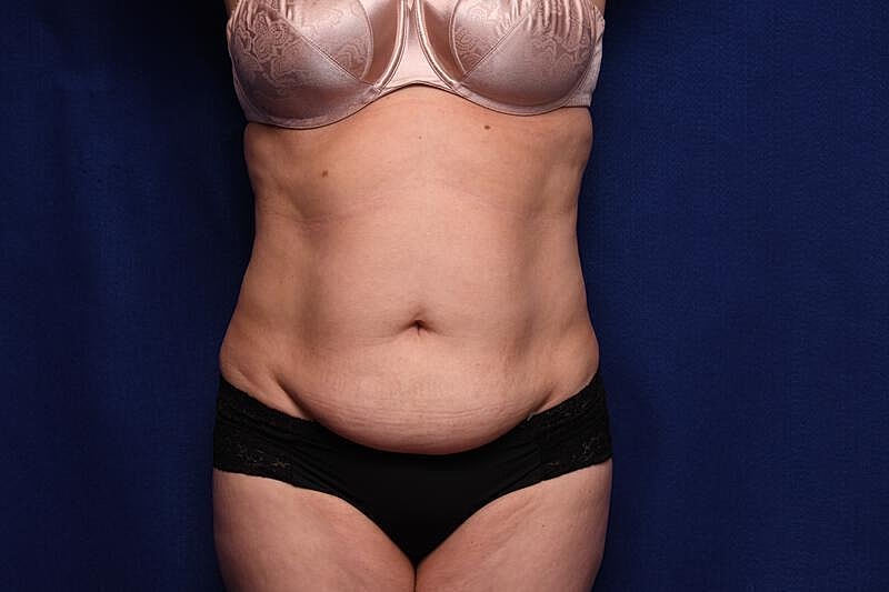 Tummy Tuck Before & After