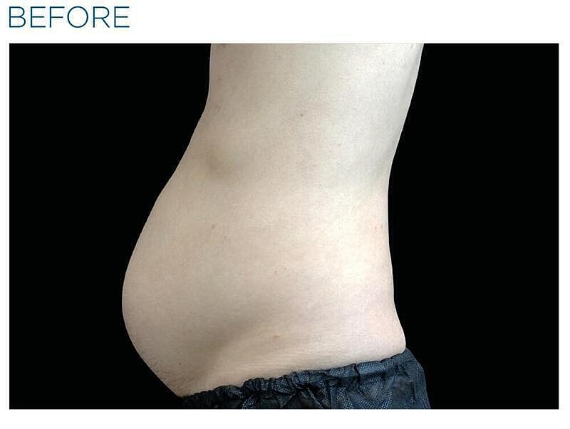 Emsculpt Abdomen Before & After